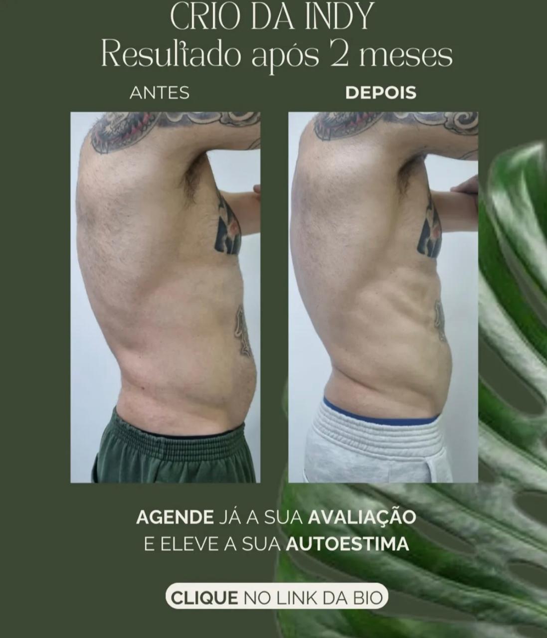 Método Crio da Indi - Caso 7